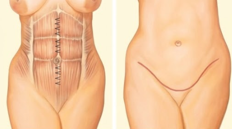Body Lift — illustration