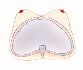 Protruding (Pigeon) Chest