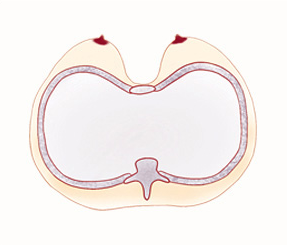 Sunken (Funnel) Chest