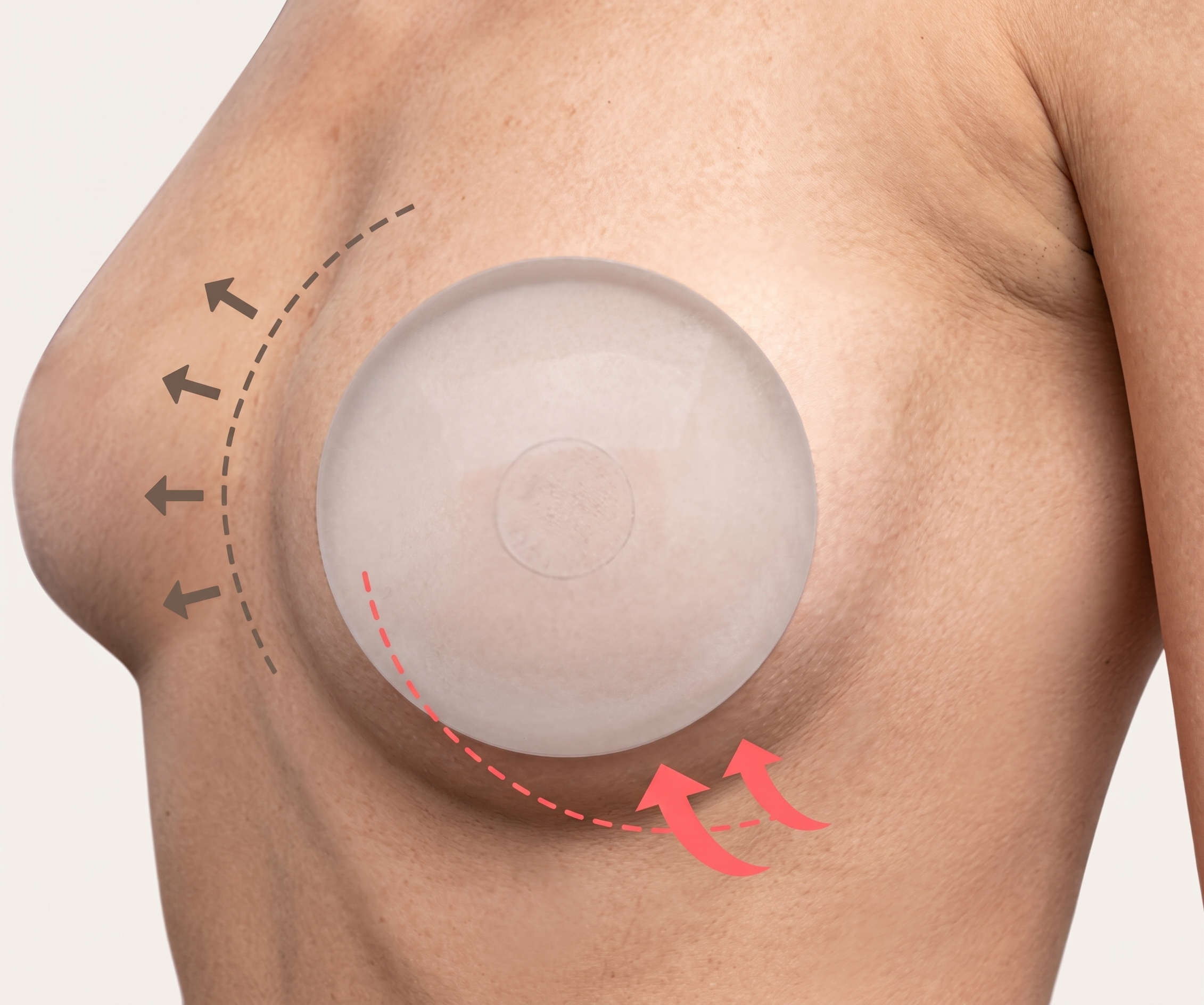 Breast Lift — illustration