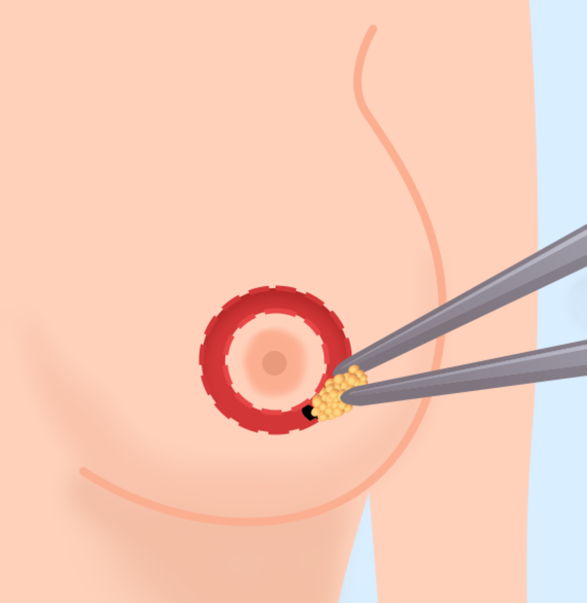 Breast Reduction — illustration