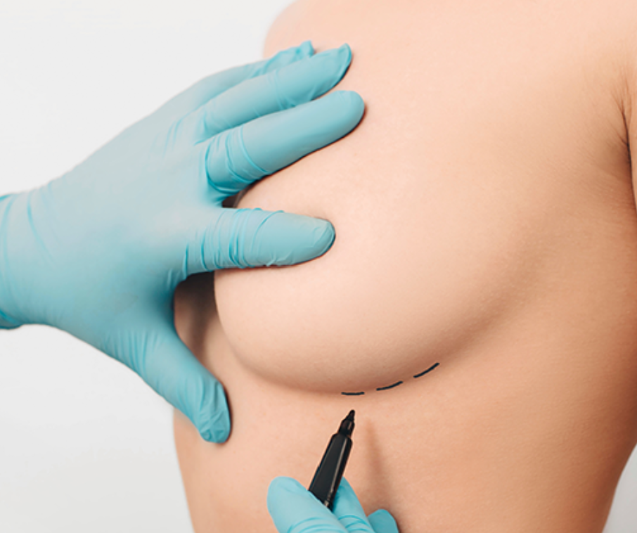 Breast Revision — illustration