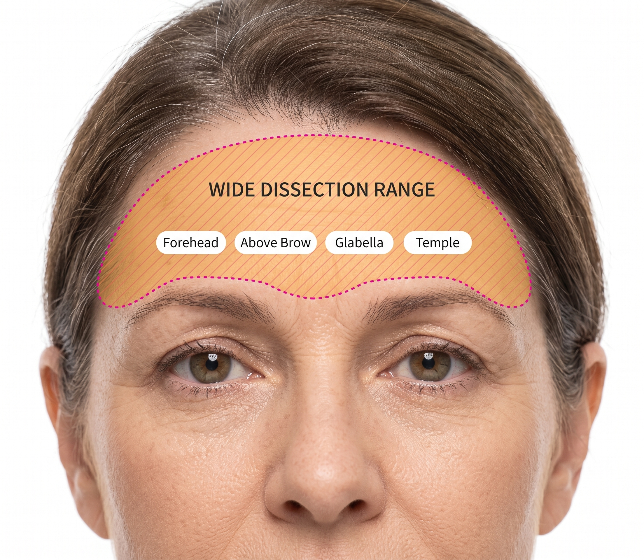 Brow Lift — illustration