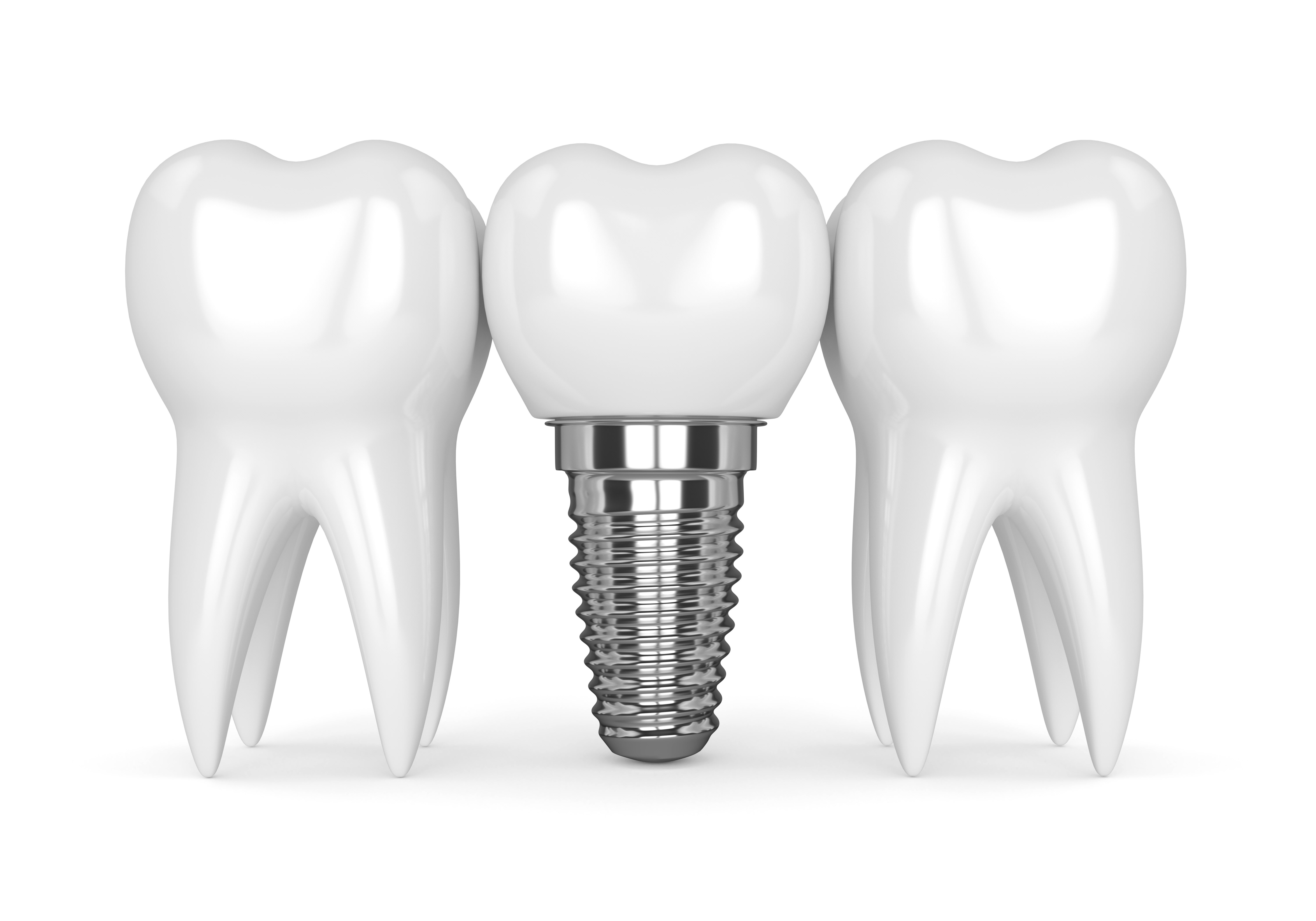 Dental Implants — illustration