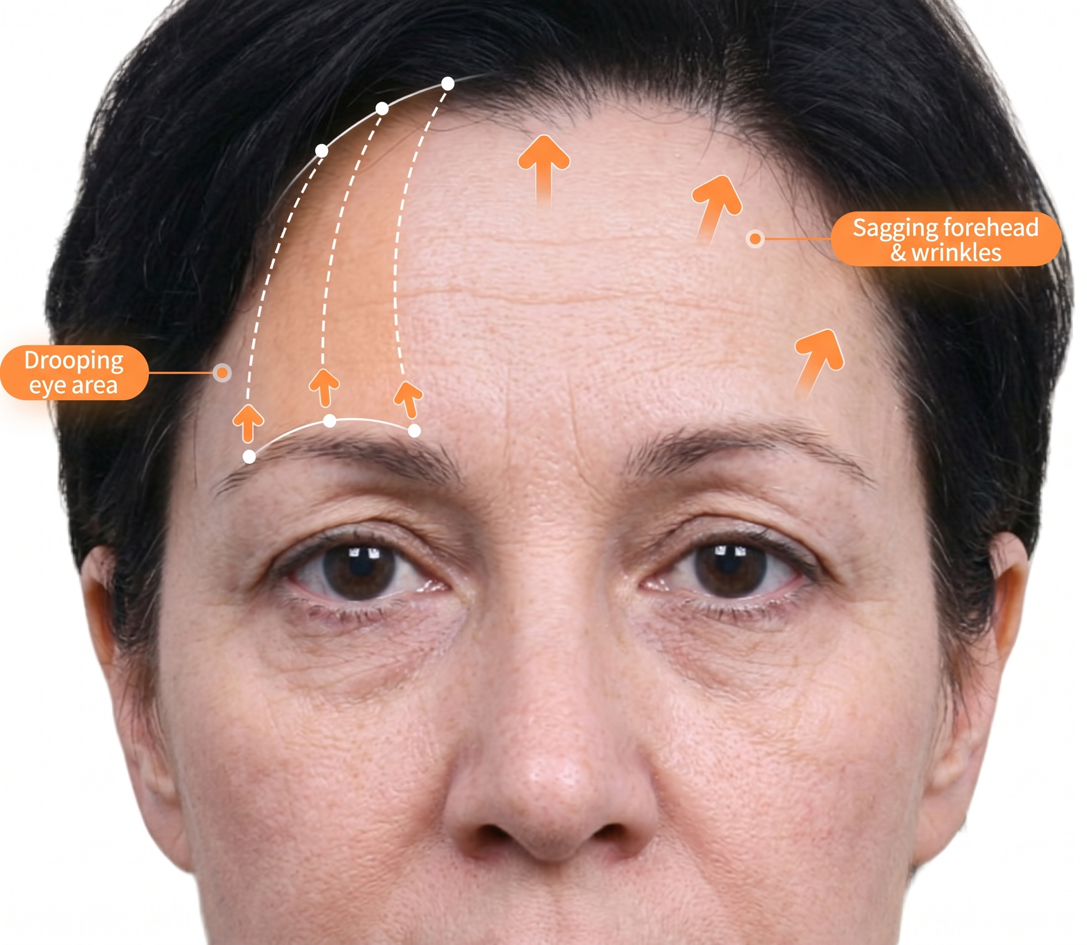 Forehead Lift — illustration