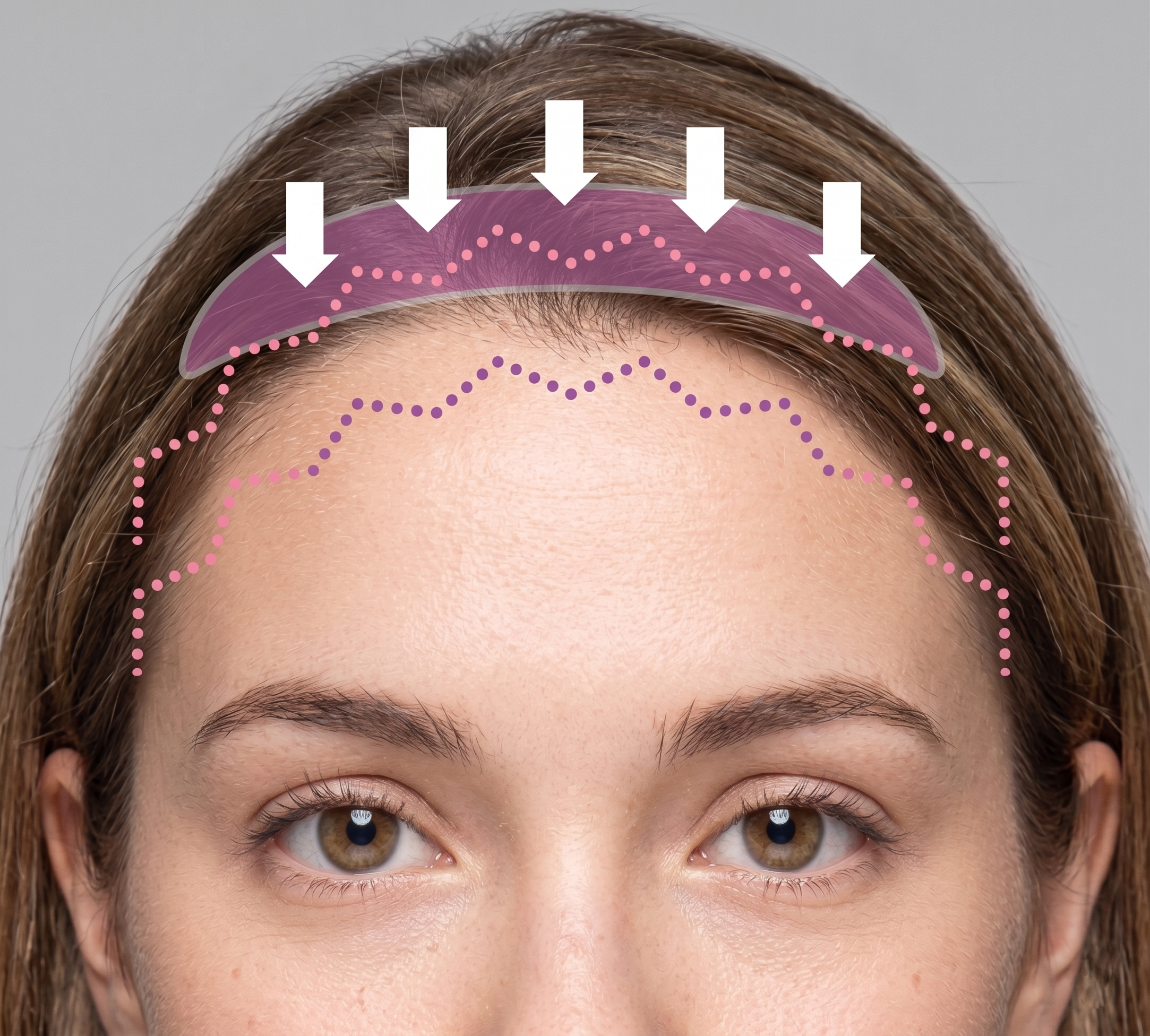 Forehead Reduction — illustration