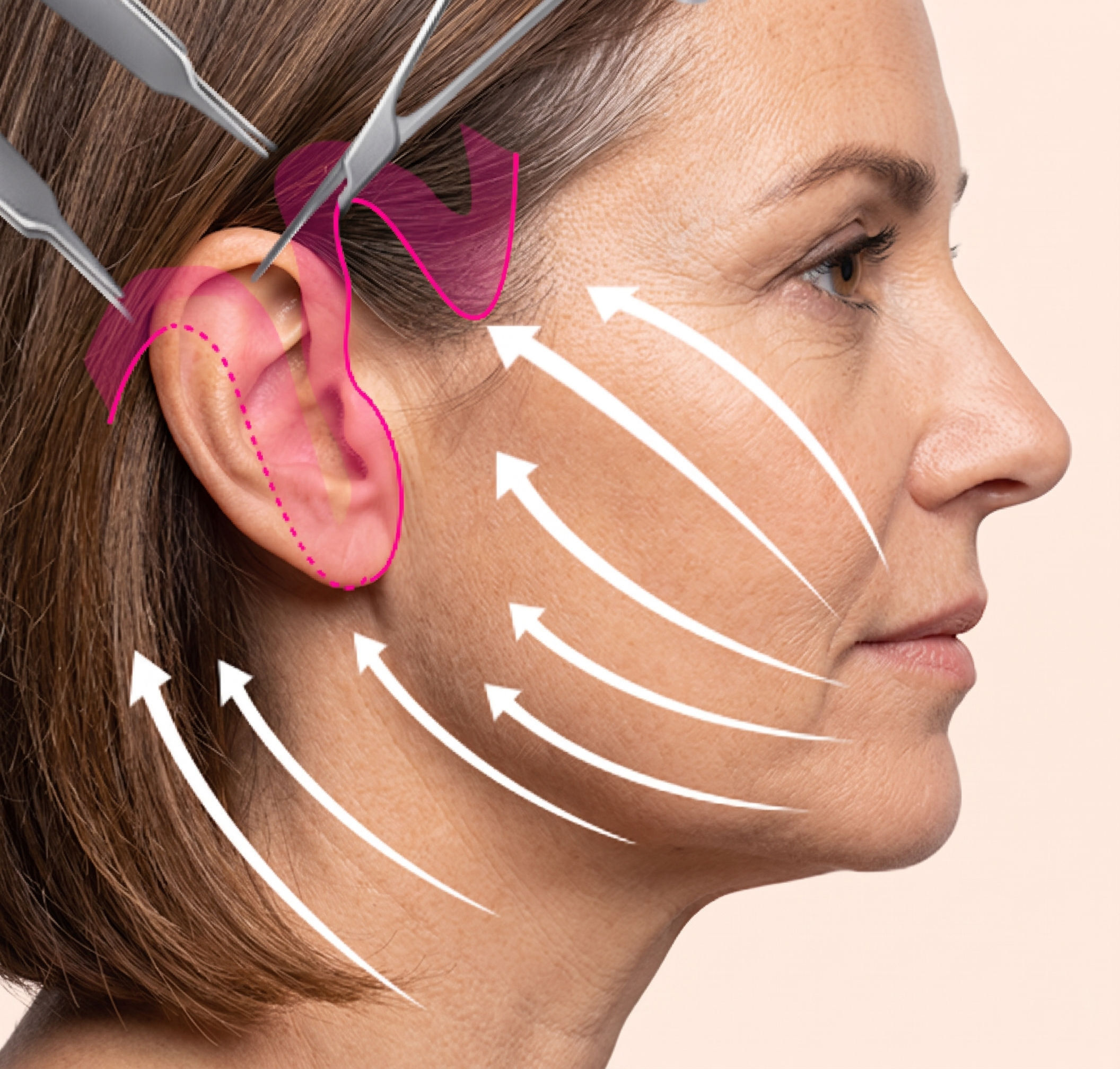 Full Facelift (Deep Plane) — illustration