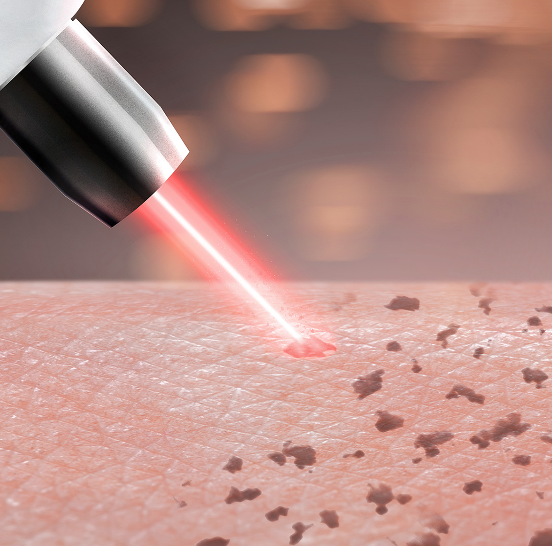 Laser Treatments — illustration