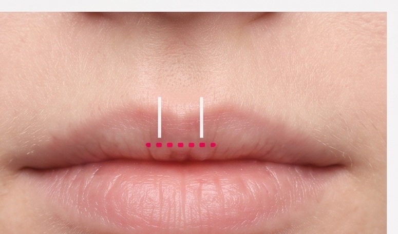 Lip Central Volume Enhancement
