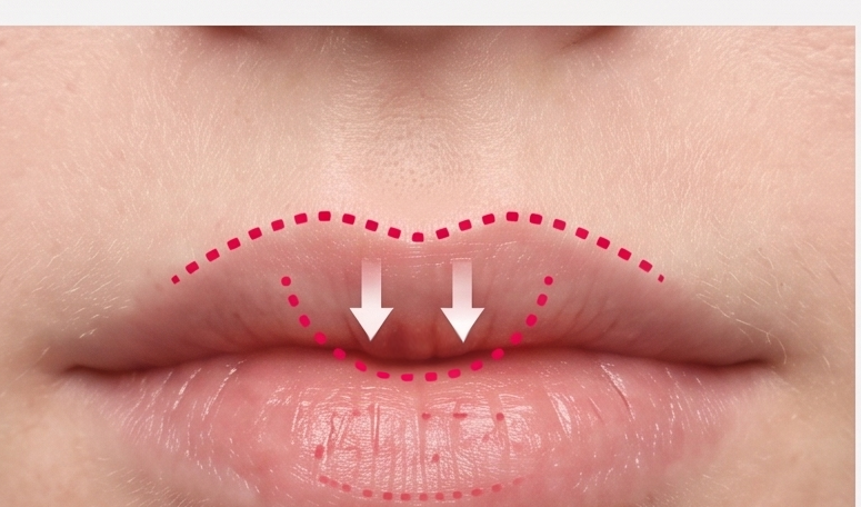 Lip Central Volume Enhancement