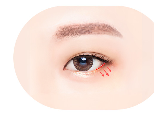 Lower Canthoplasty