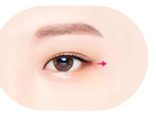 Outer Canthoplasty