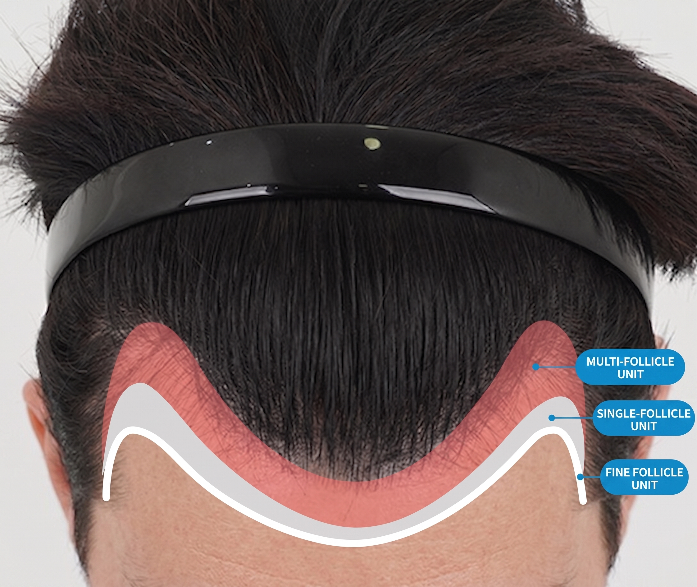 Hairline zones — multi-follicle, single-follicle and fine follicle units