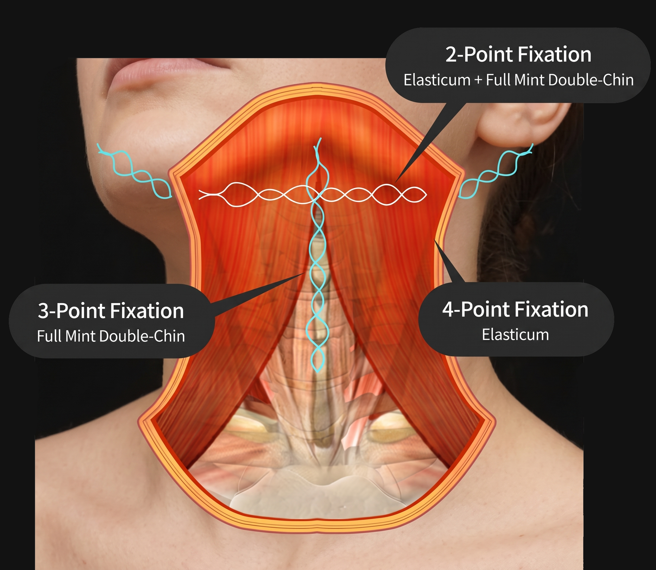 Neck Lift — illustration