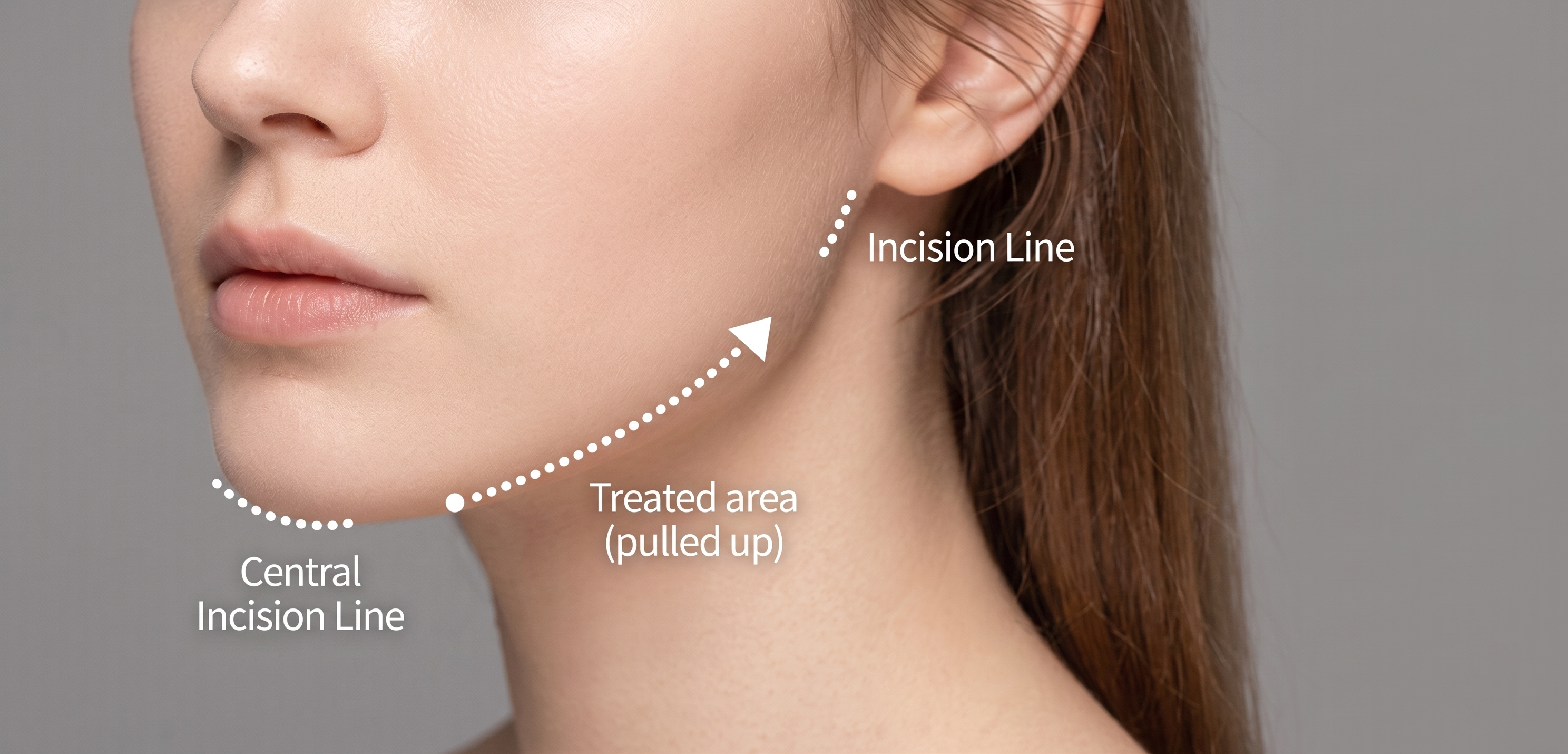 Incision and treated area