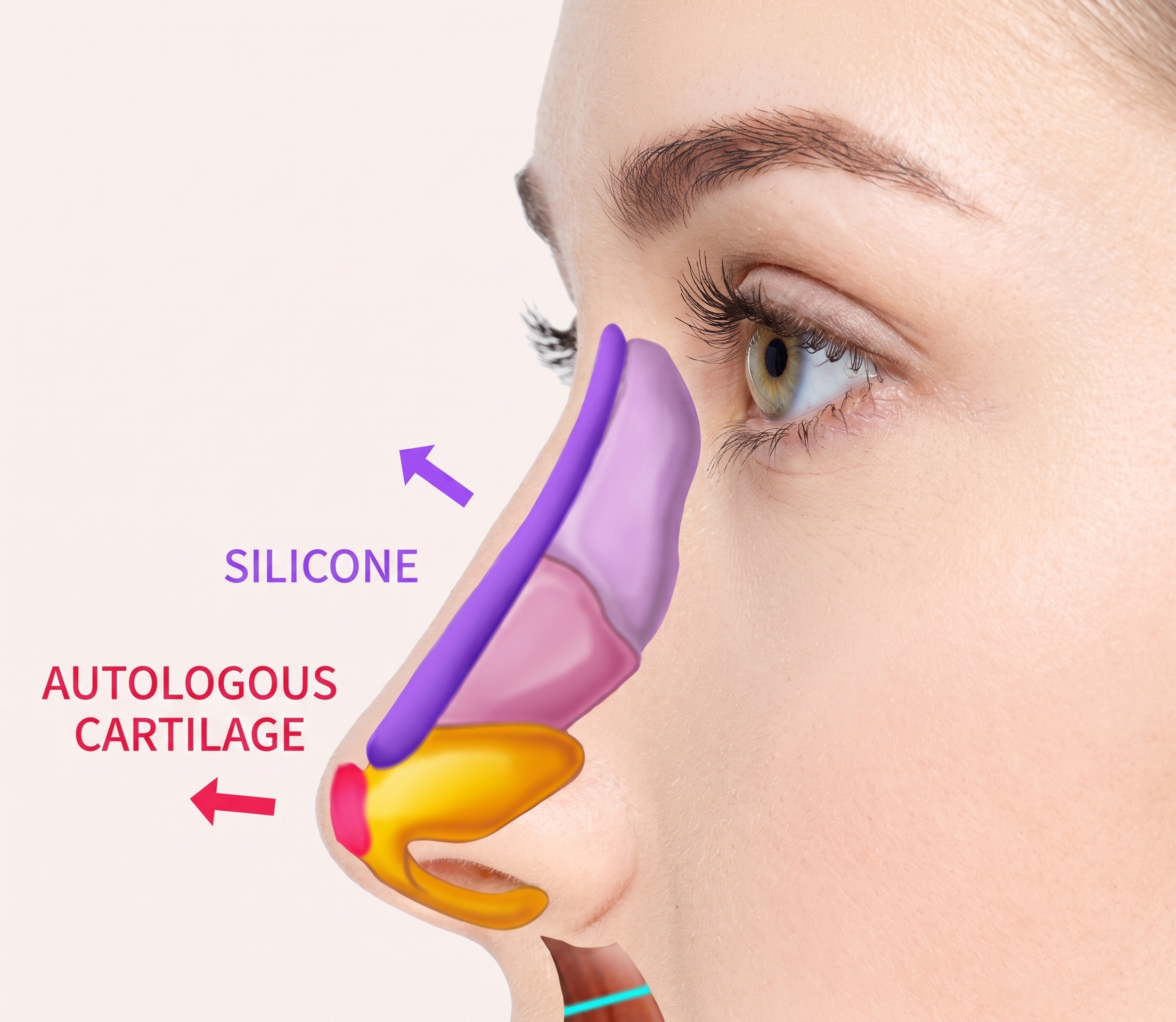 Nose Bridge Augmentation — illustration