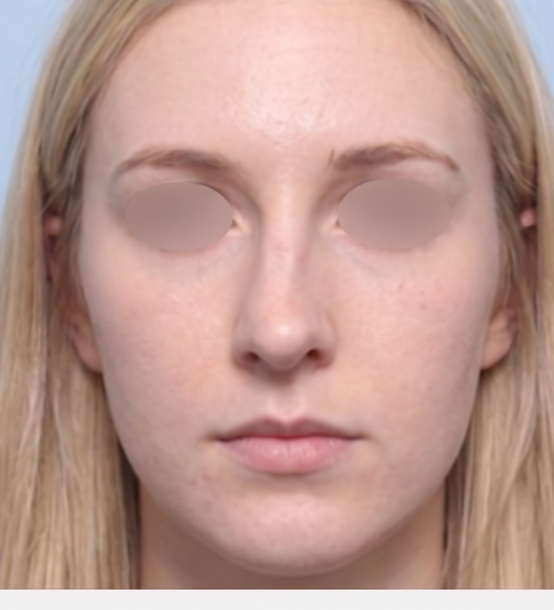 Deviated Nose Correction