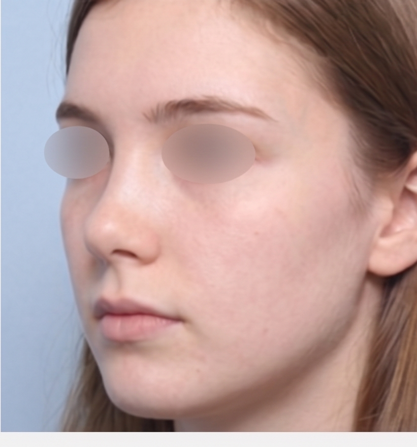 Short Nose Correction