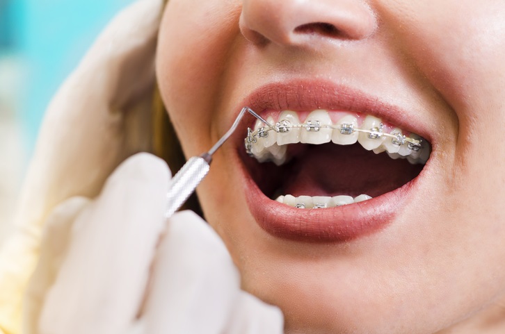Orthodontics — illustration