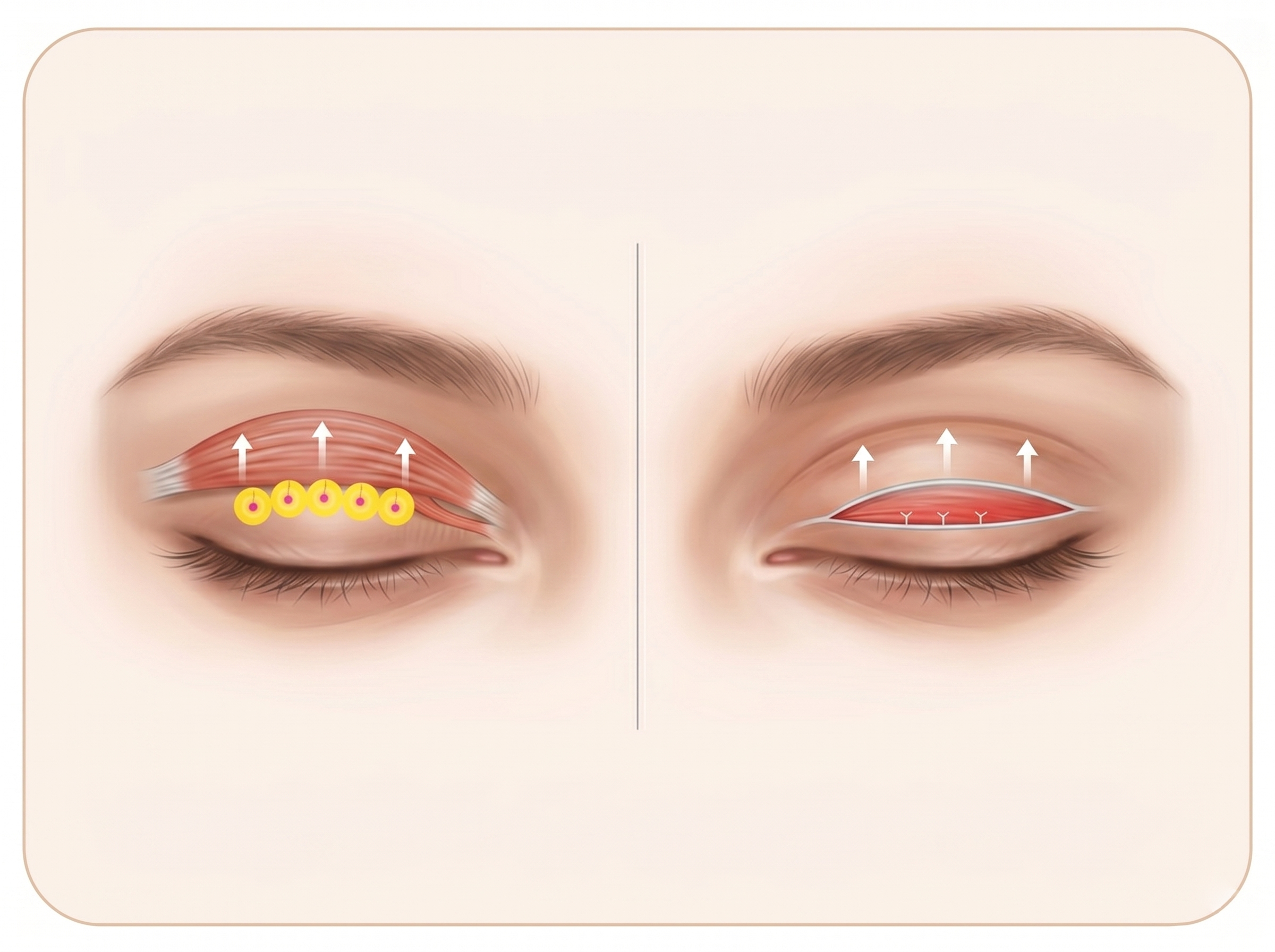 Ptosis Correction — illustration
