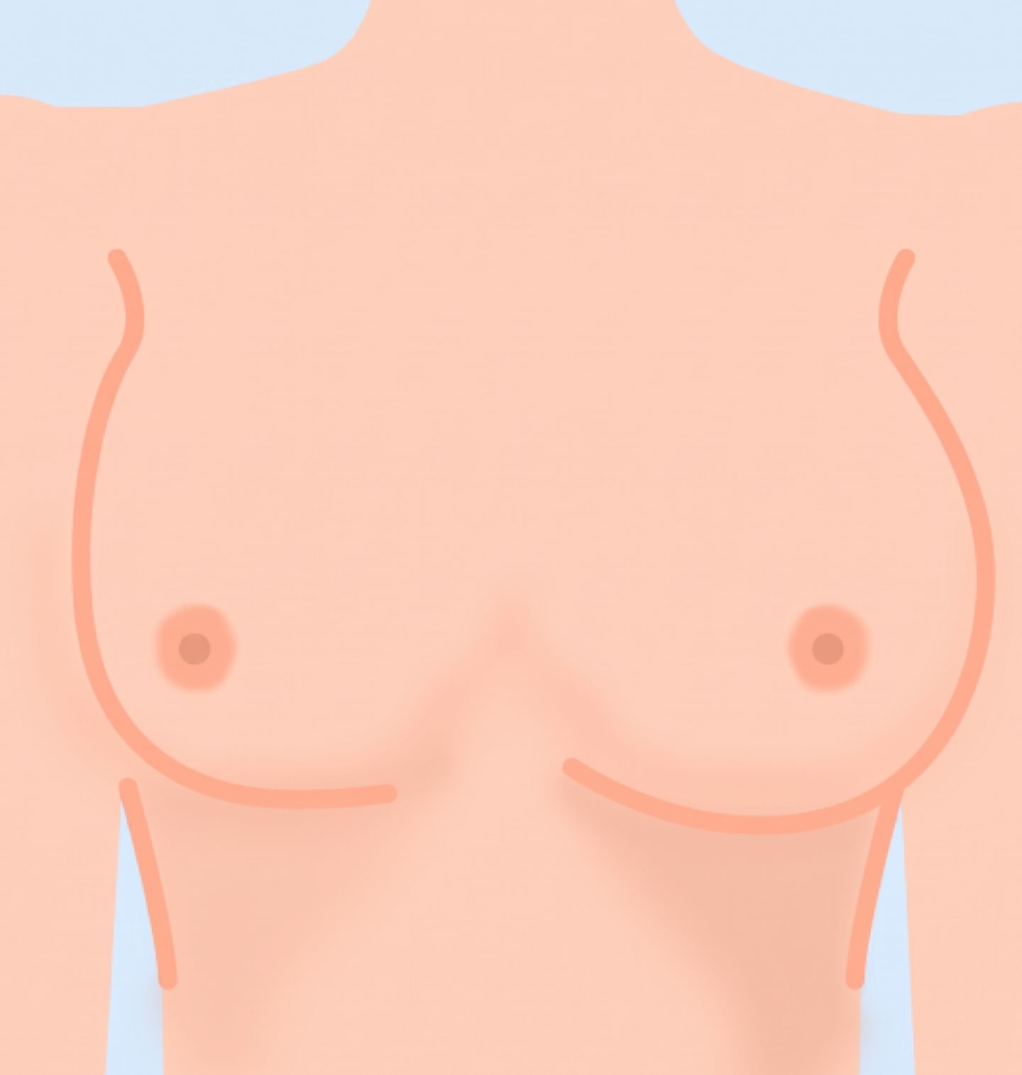1. Bilateral Breast Asymmetry