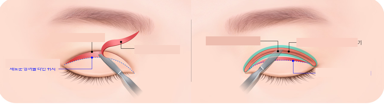 Eye revision surgery techniques