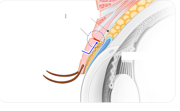 Release the old adhesion