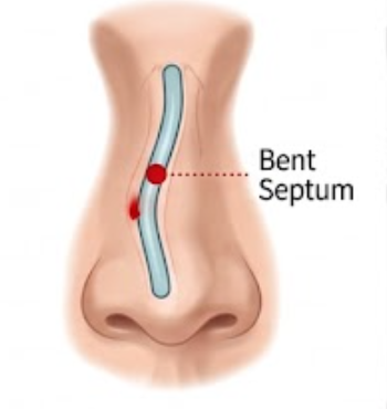 Deviated Septum