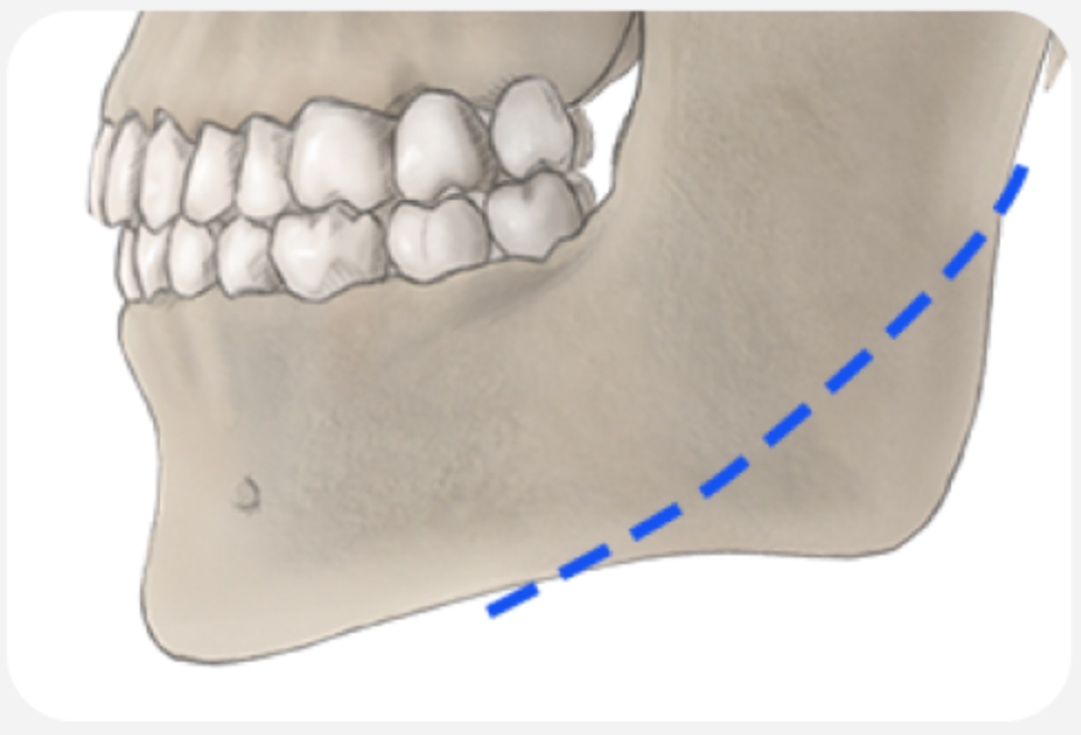 01. Mandibular Angle Reduction (Osteotomy)