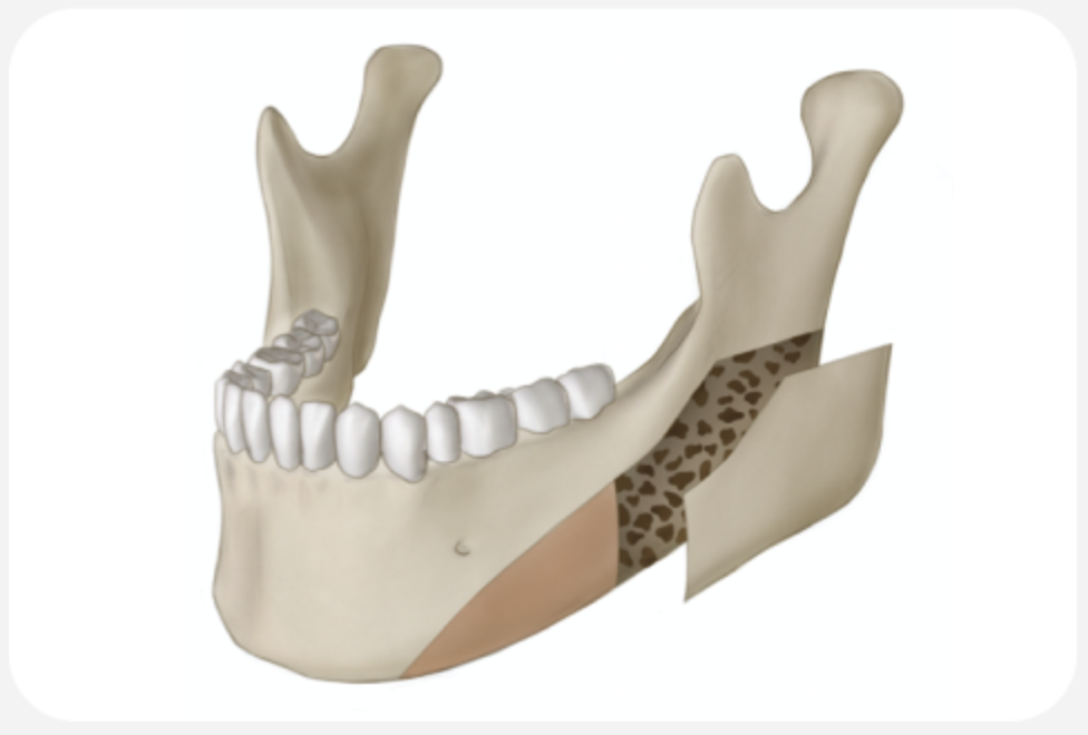 02. Cortical Bone Reduction (Outer-Cortex Shaving)