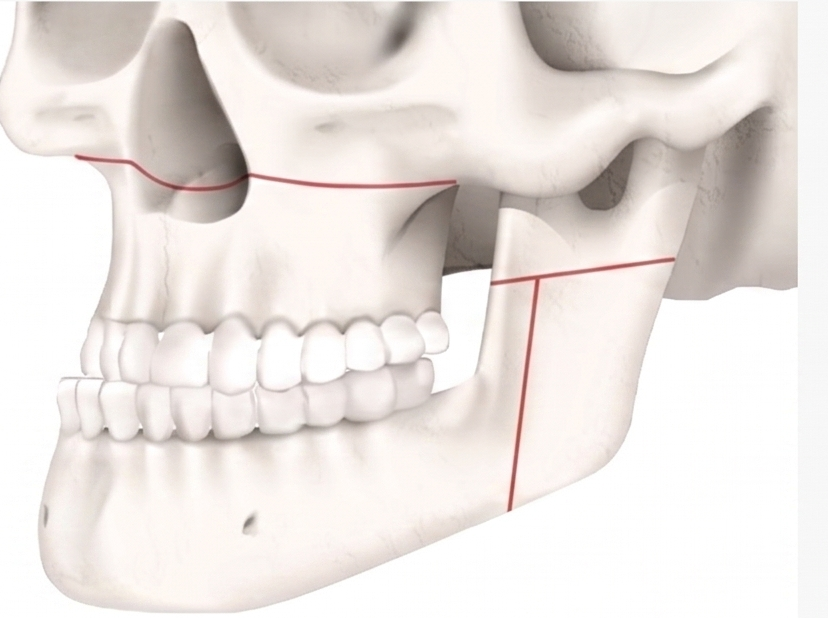 Malocclusion / Prognathism (Lantern Jaw)