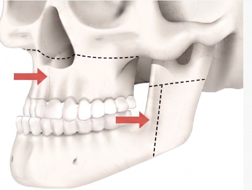 Malocclusion / Prognathism (Lantern Jaw)