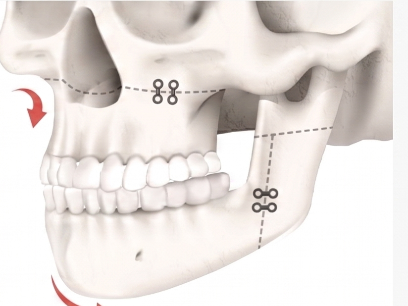 Malocclusion / Prognathism (Lantern Jaw)