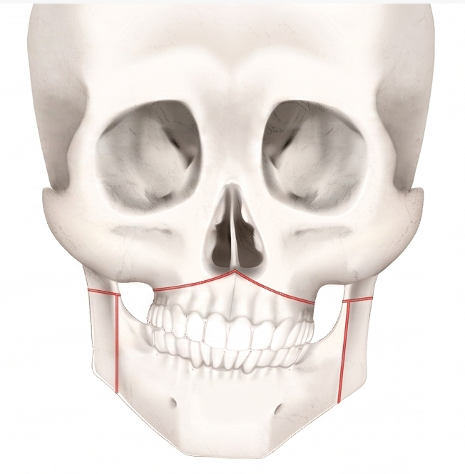 Facial Asymmetry