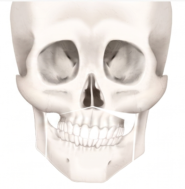 Facial Asymmetry