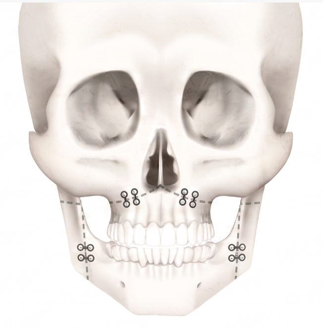 Facial Asymmetry